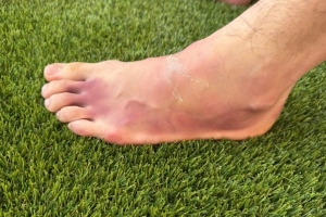 早日康复！前国脚商毅晒儿子商竣程的受伤左脚，左脚淤血严重